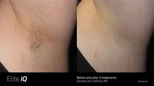 Laser Hair Removal Services Pitt Meadows | Langley | Port Coquitlam | Maple  Ridge